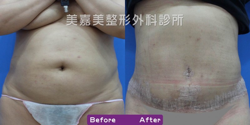 腹部拉皮案例