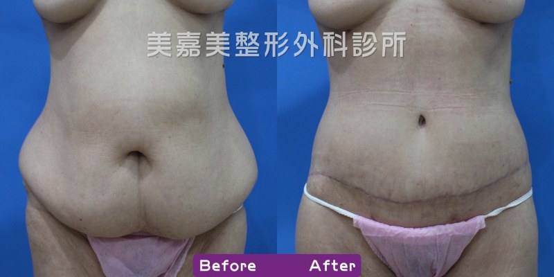 腹部拉皮案例