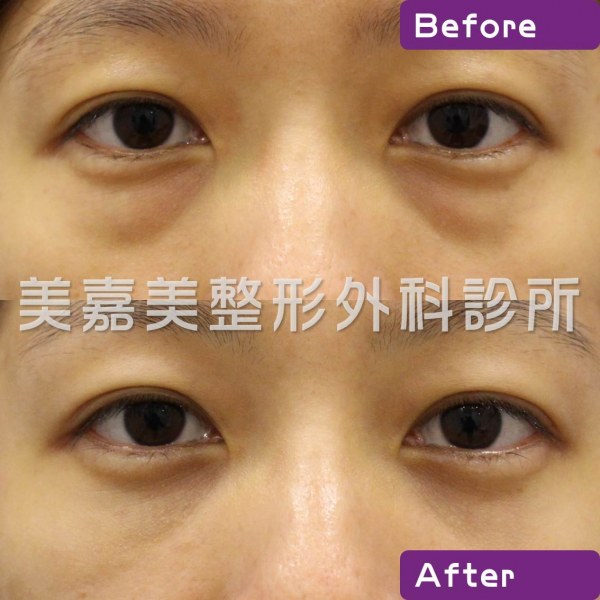眼袋手術案例