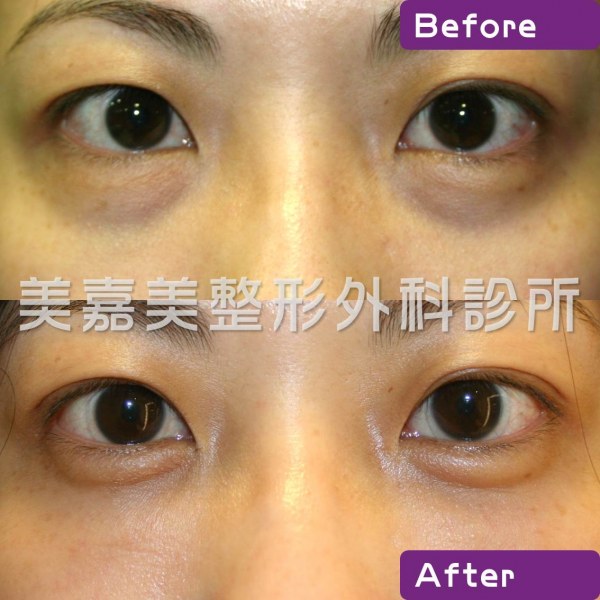 眼袋手術案例