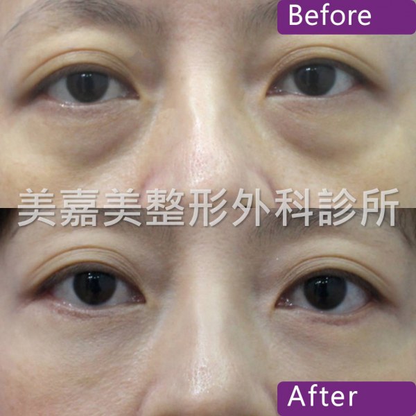 眼袋手術案例