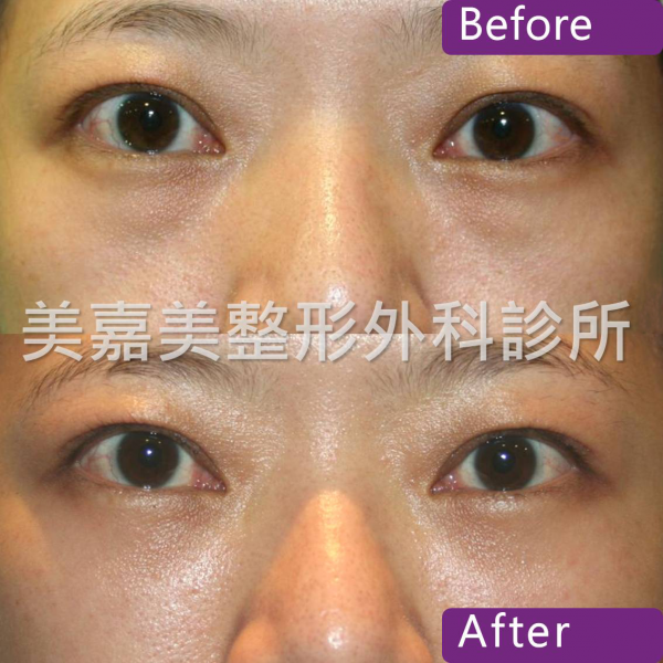 眼袋手術案例