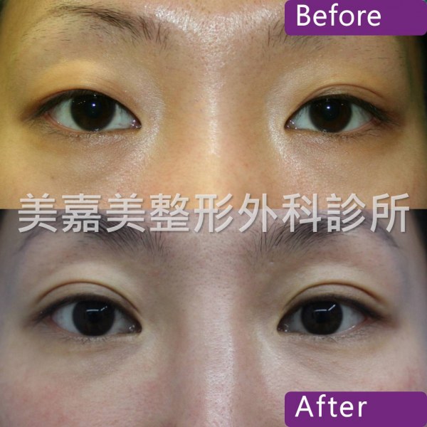 雙眼皮手術案例