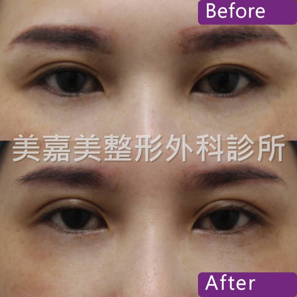 雙眼皮手術案例