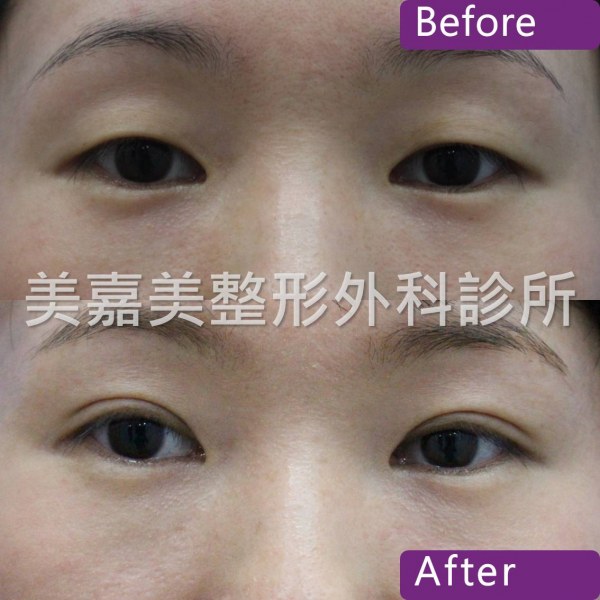 雙眼皮手術案例