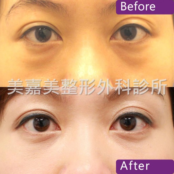 眼袋手術案例