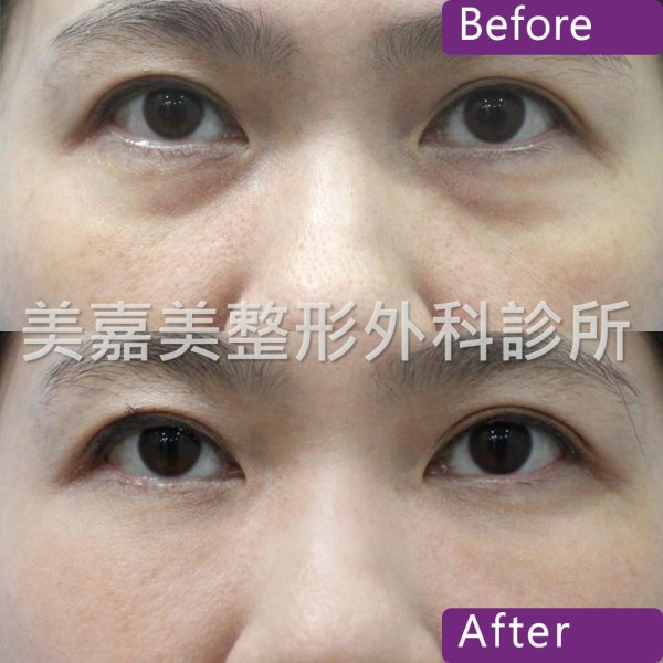 眼袋手術案例