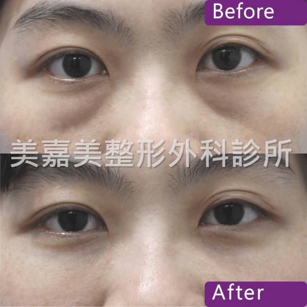 眼袋手術案例