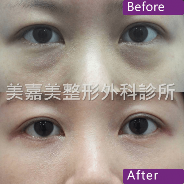 眼袋手術案例