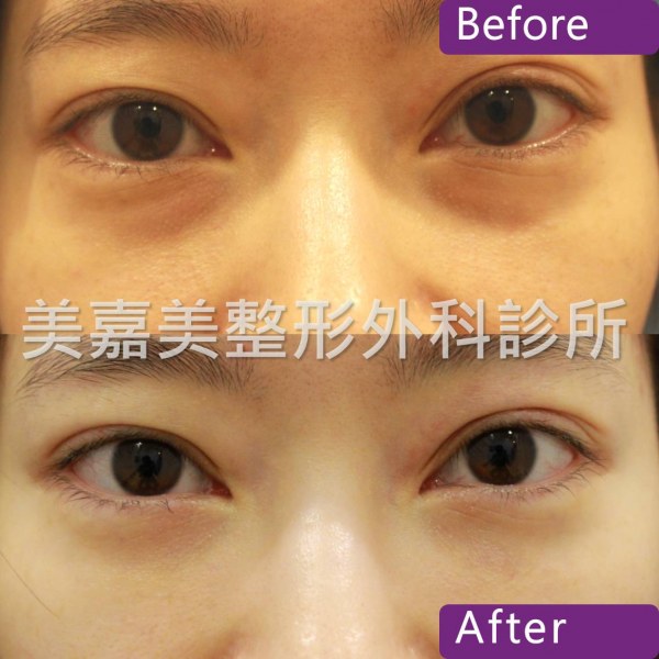 眼袋手術案例
