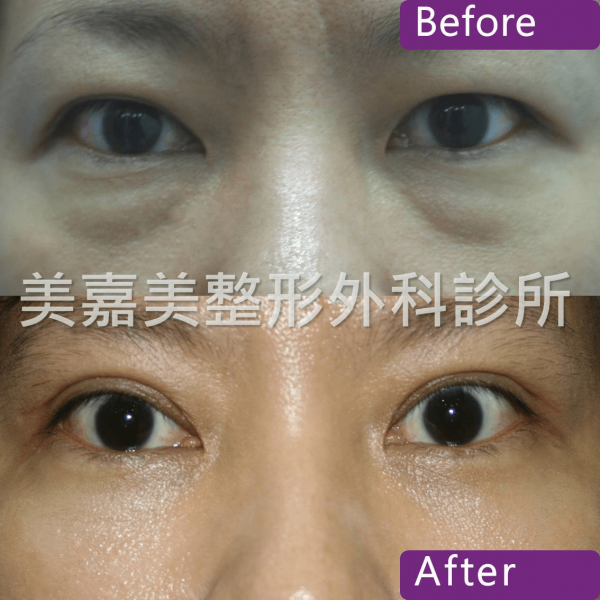 眼袋手術案例