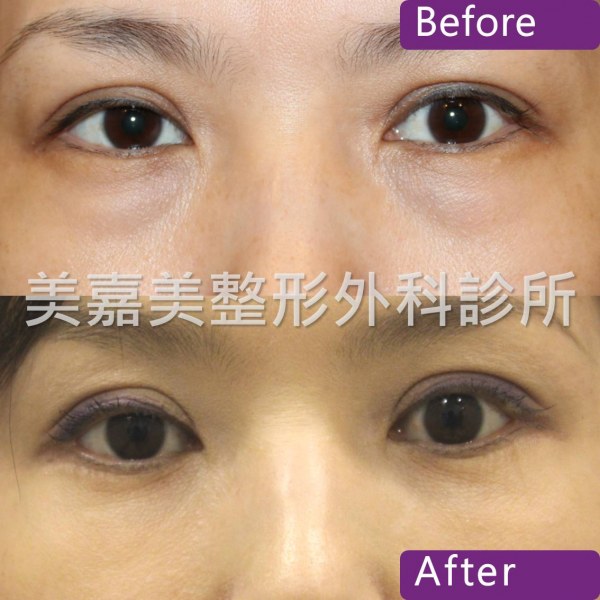 眼袋手術案例