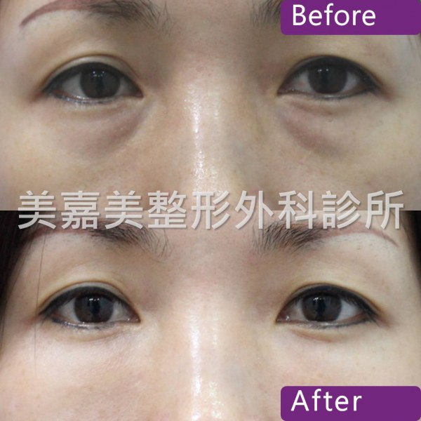 眼袋手術案例