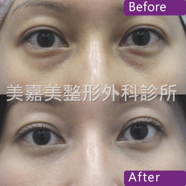 眼袋手術案例