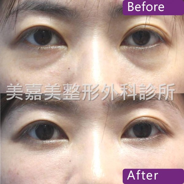 眼袋手術案例