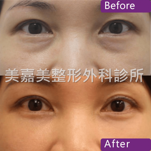 眼袋手術案例
