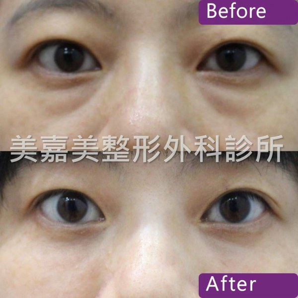 眼袋手術案例