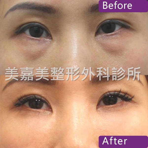 眼袋手術案例
