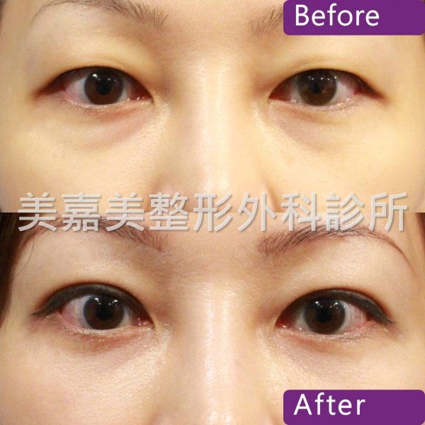 眼袋手術案例