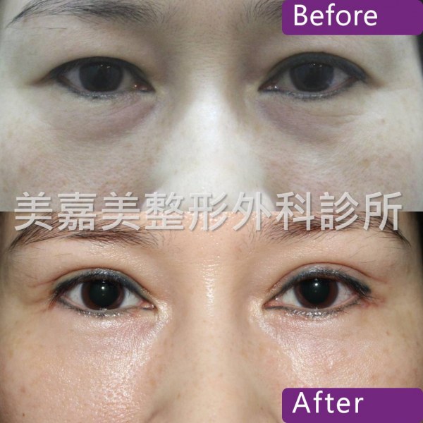 眼袋手術案例