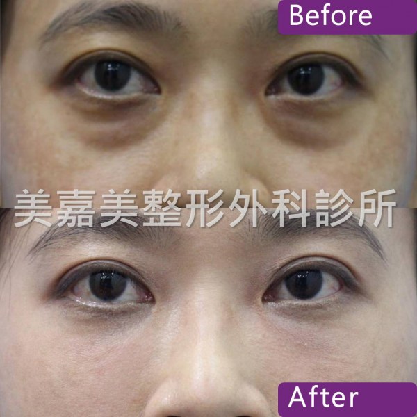 眼袋手術案例