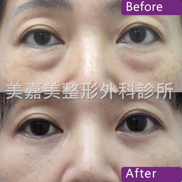 眼袋手術案例