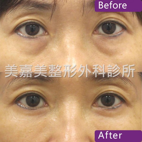 眼袋手術案例