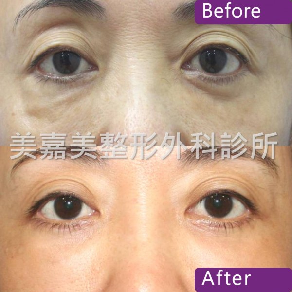 眼袋手術案例