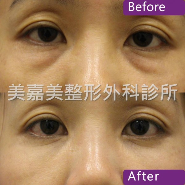 眼袋手術案例