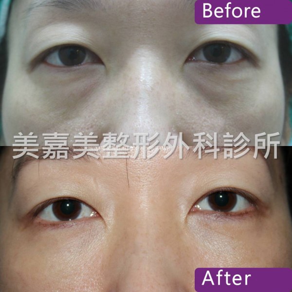 眼袋手術案例