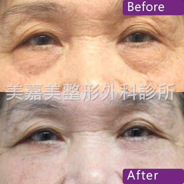 眼袋手術案例