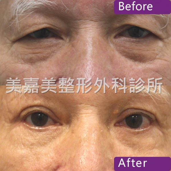 眼袋手術案例