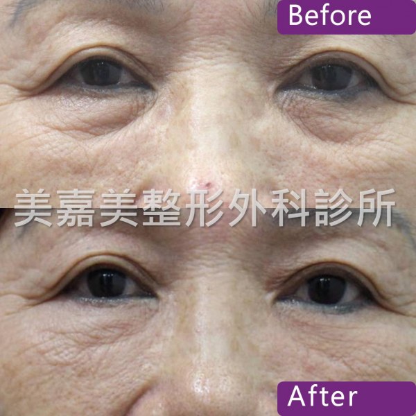 眼袋手術案例