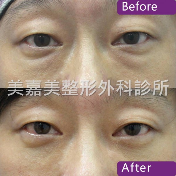 眼袋手術案例