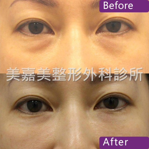 眼袋手術案例