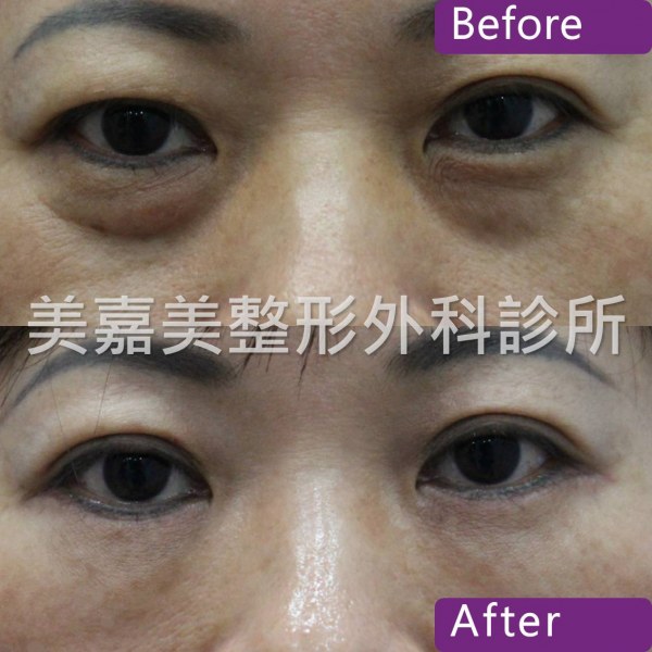 眼袋手術案例