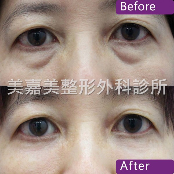 眼袋手術案例