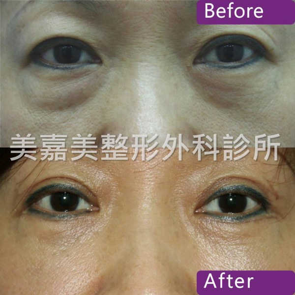 眼袋手術案例