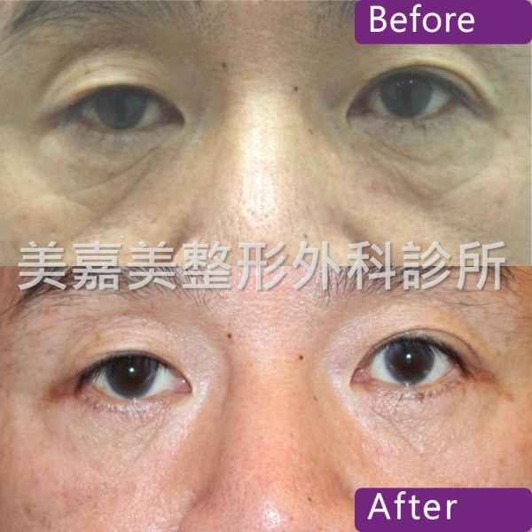 眼袋手術案例