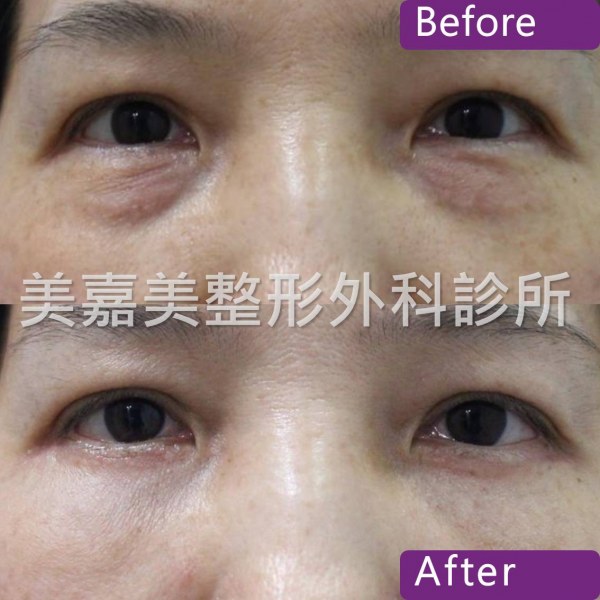 眼袋手術案例