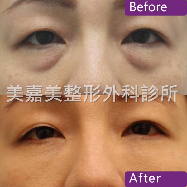 眼袋手術案例