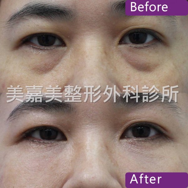 眼袋手術案例