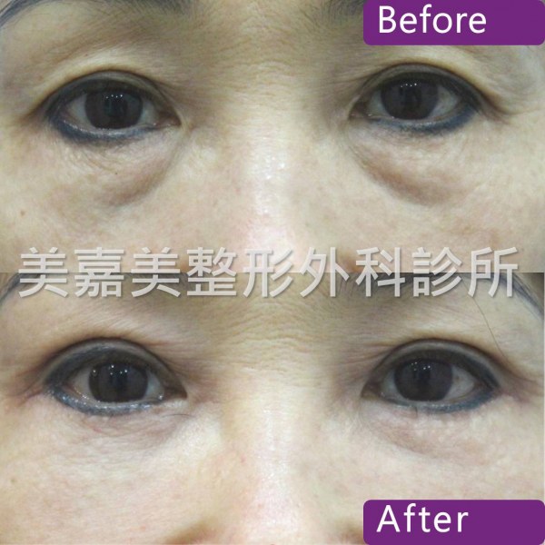 眼袋手術案例