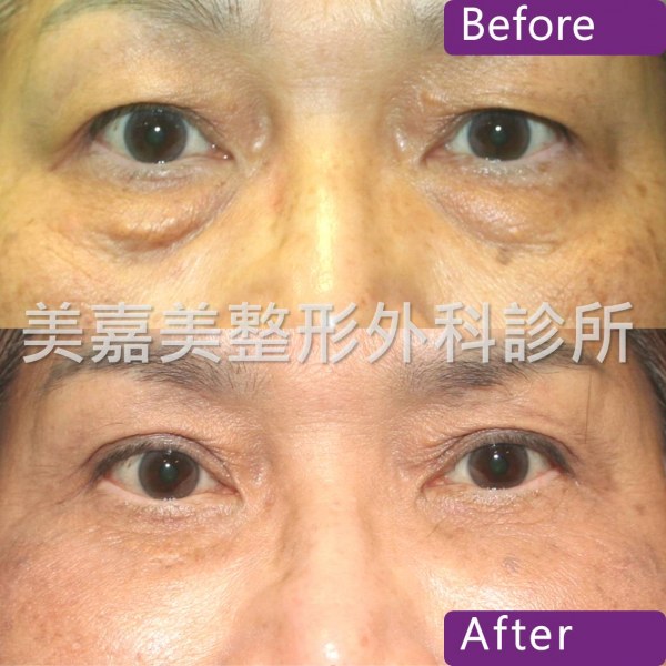 眼袋手術案例