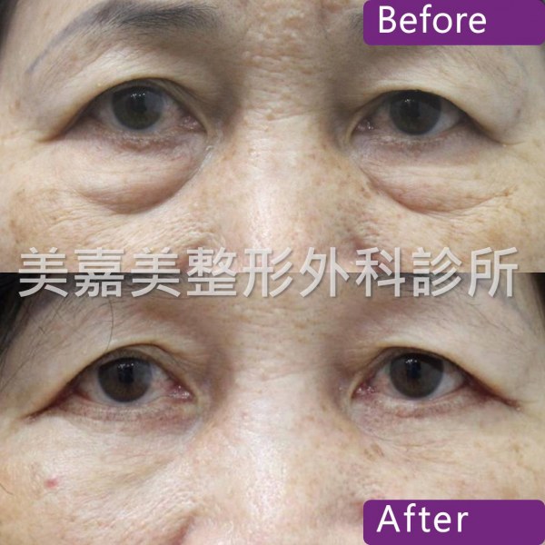 眼袋手術案例
