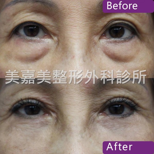 眼袋手術案例