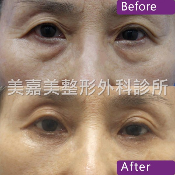 眼袋手術案例