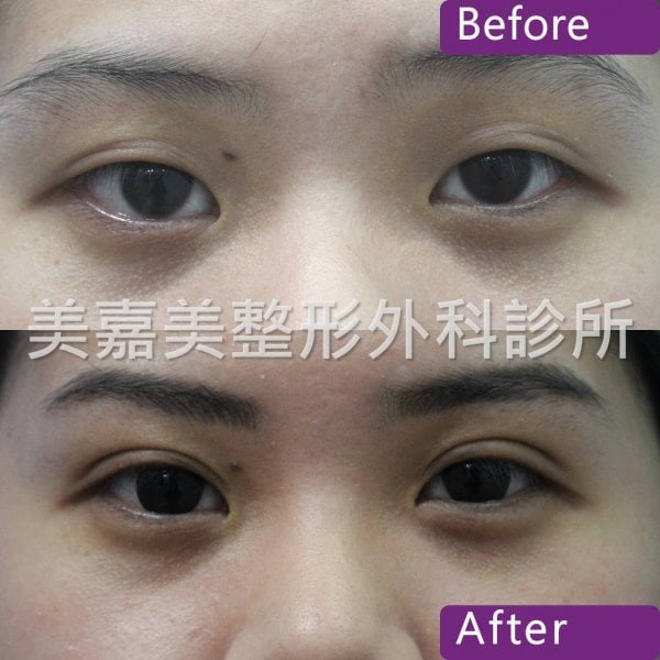 雙眼皮手術案例