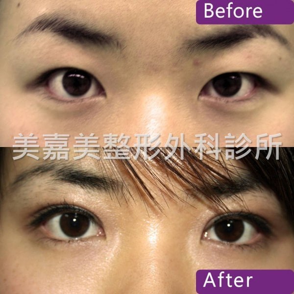 雙眼皮手術案例