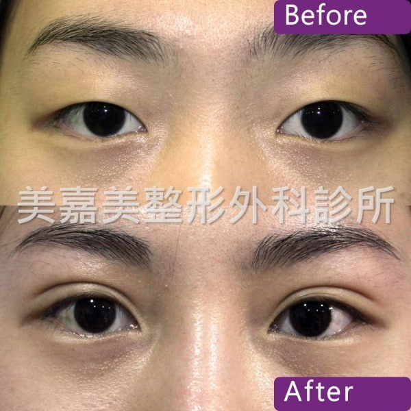 雙眼皮手術案例